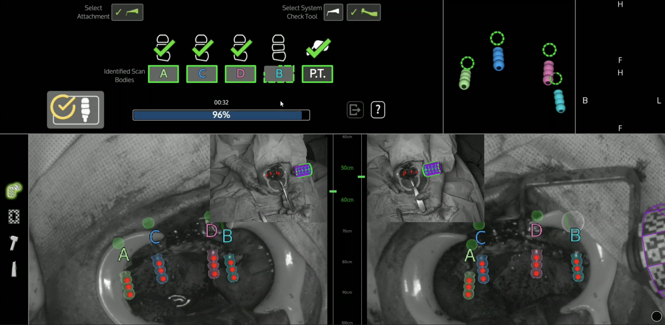 Fig. 6: FastMap photogrammetry interface showing registration of the four scan bodies connected to the zygomatic implants.