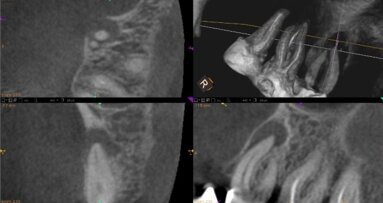Precyzyjna ocena obecności, lokalizacji i rozmiaru zmian okołowierzchołkowych z wykorzystaniem CBCT