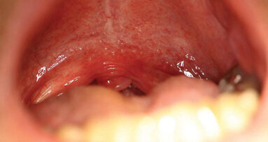 Silence snoring with ‘NIGHTLASE’ and cutting-edge laser esthetic applications