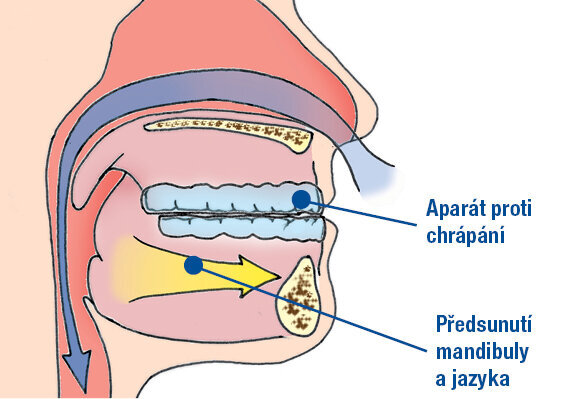 Aparát proti chrápání