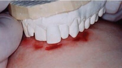 Os pesquisadores argumentam que é tempo de parar de usar as marcas de mordida em medicina forense