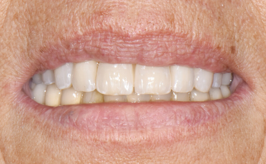 Fig. 15 - Protesi definitiva tipo Toronto in sede (a 7 giorni dall’intervento chirurgico).