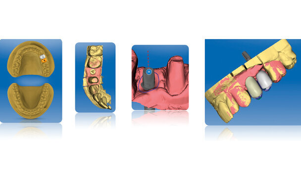 Odontoiatria digitale: gli scanner intraorali