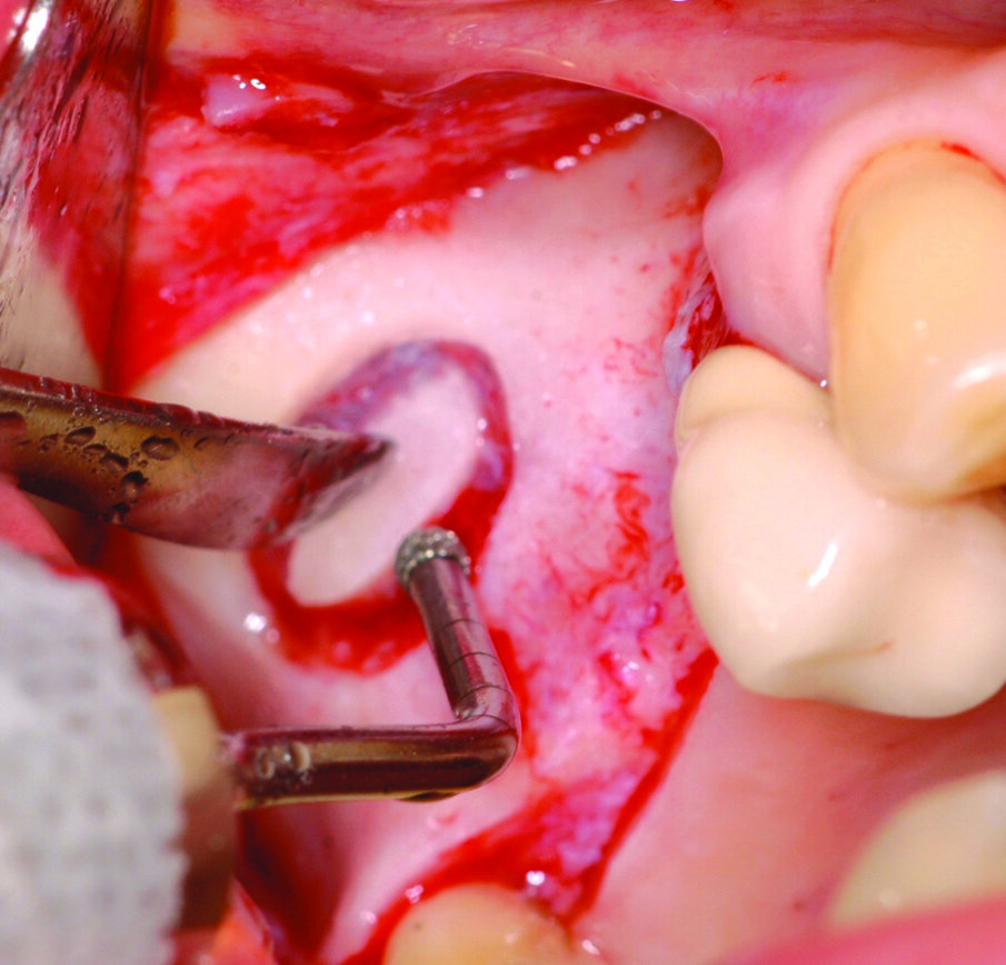 Fig. 4_Fasi iniziale dell’antrostomia con bisturi piezoelettrico.