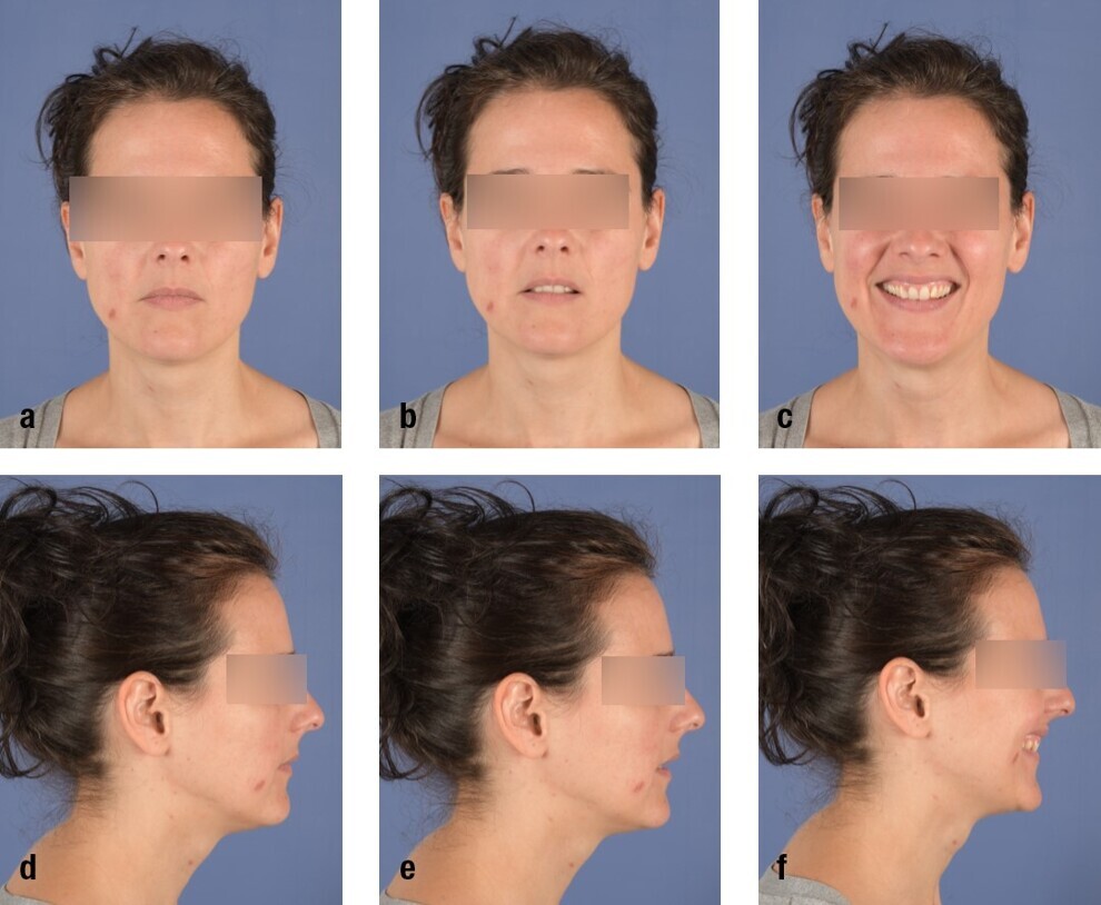 Figs. 31a–f: Pretreatment extra-oral photographs.