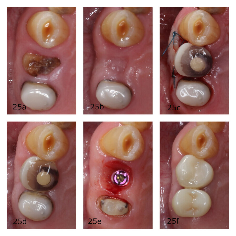 Figs. 25a–f: Situation at each step of treatment.