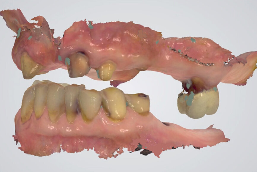 Fig. 27: Digital recording of centric relation using a conventional finding method with a composite device at the desired vertical dimension of occlusion.
