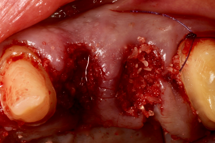 Fig. 6: Clinical situation after extraction of teeth #24 and 25 and augmentation with autologous dentine.