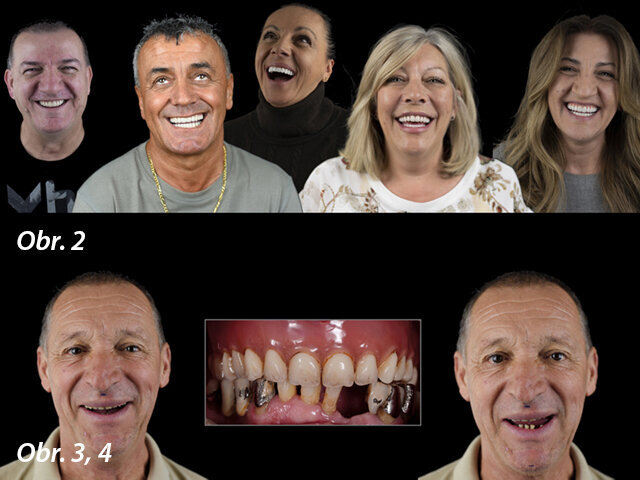 Dřívější úspěšná ošetření pomocí našeho „procesu estetické náhrady nesené implantáty“ / Pacient – fotodokumentace počáteční situace