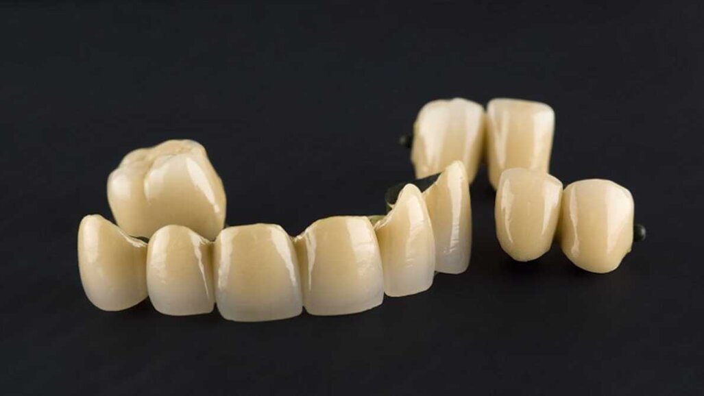 Kovinska keramika je še vedno zlati standard, kaže študija