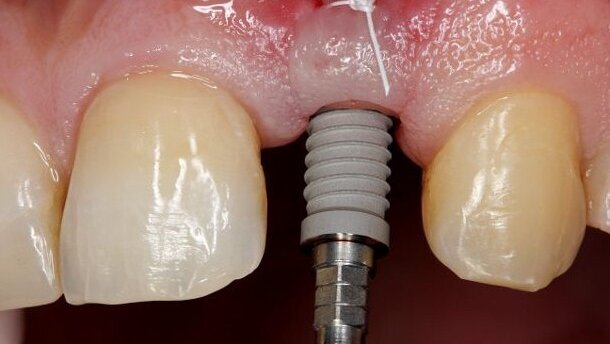 Implantologie-Update: Sofortversorgung und Platform Switching