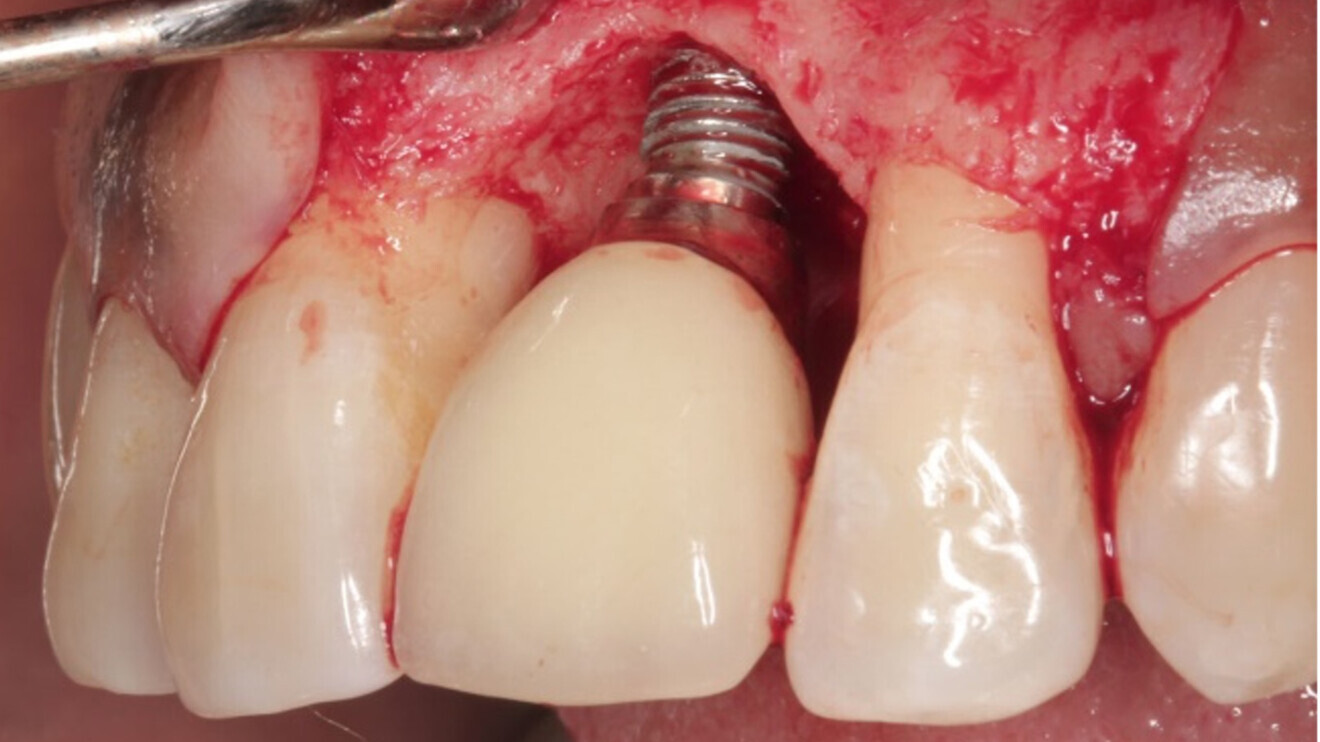 Research shows that nearly half of dental implant patients experience peri-implant mucositis, often leading to peri-implantitis, which affects 22% of patients and is a leading cause of implant failure. (Image: Karapataki et al. 2023)