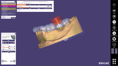 exocad – Quick Guide: Get most out of guided Surgery