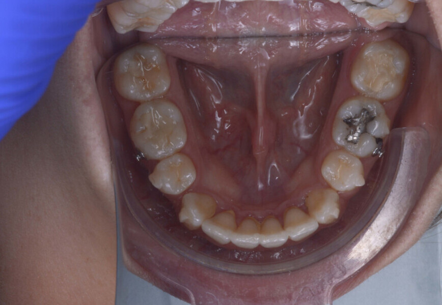 Fig. 6f: Intra-oral and occlusal photographs during treatment (after the 32nd aligner pair).