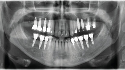 Cas clinique de chirurgie guidée : Extraction, implantation et mise en esthétique immédiate