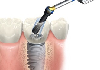 Nobel Biocare – NobelProcera FCZ Implant Crown