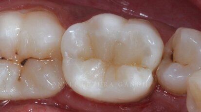 Cuspal layering technique to produce aesthetic posterior composite restorations – A case report