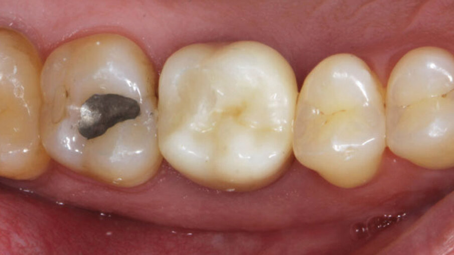 Fig. 13_Foto controllo (vista occlusale) a 2 anni.