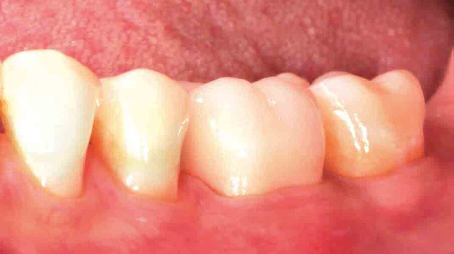 Fig. 11: At the check-up several days after crown placement, a great overall picture is obtained. The patient is happy with the final restoration in terms of aesthetics and function.