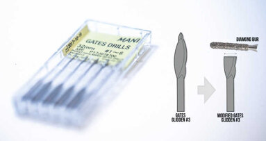 Gestion d’instruments intra canalaires fracturés : étude de cas clinique