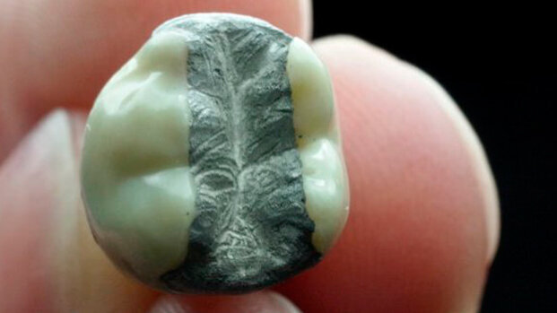 Medicine alternative per far fronte ai problemi dell’amalgama dentale