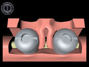 Implant placement Papilla regeneration technique (P. Palacci) allows using a double rotation of the tissues to recreate the lost central papilla. These elements combined make it possible to obtain a satisfactory aesthetic and functional result.