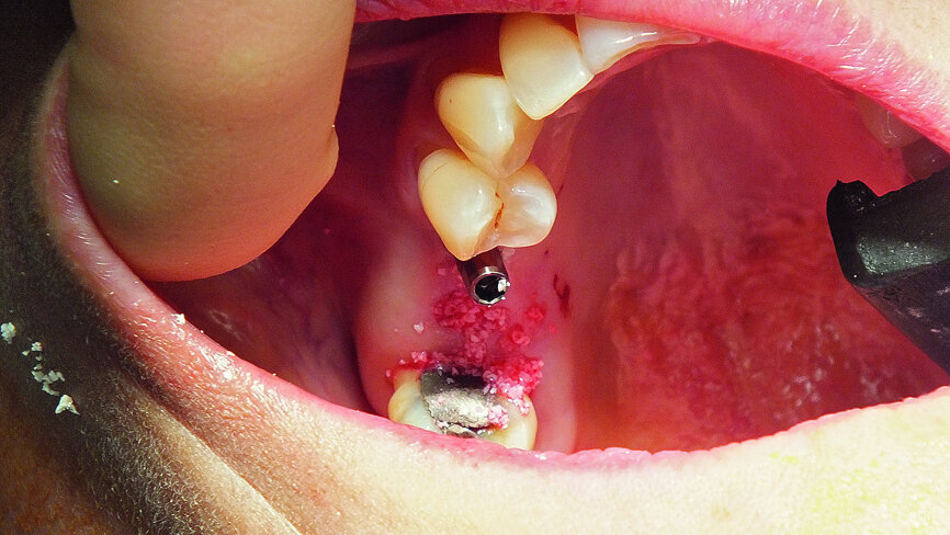 Fig. 15: A heterogeneous bovine bone graft material (Bio-Oss) was introduced into the implant site.