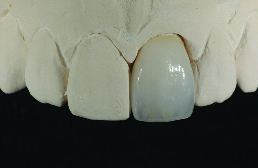 Fig. 8, 9 and 10: The completed crown on the model.