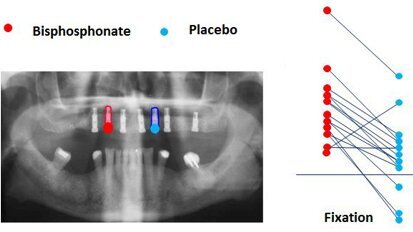 Un nouveau revêtement accélère la fixation des implants dentaires