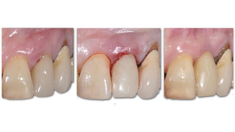 Fig. 12_Confronto tra la situazione iniziale, quella post-chirurgica e quella al termine del periodo provvisorio.