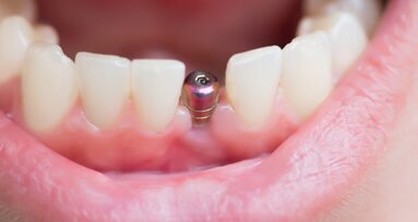 Retrospective analysis of periimplantitis therapy of 158 implants