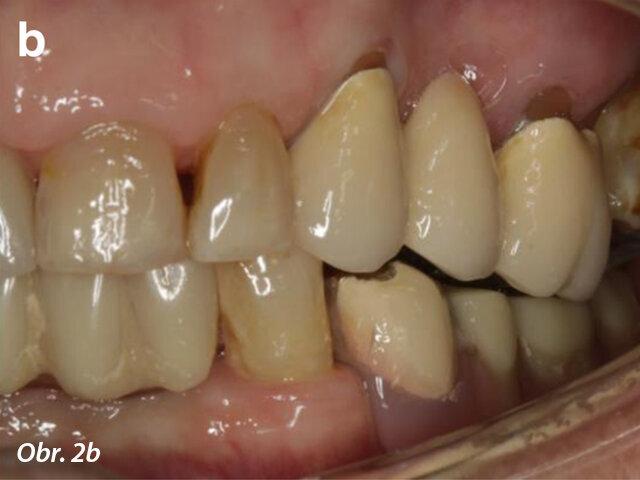 Počáteční stav chrupu: pravá strana (a) a levá strana