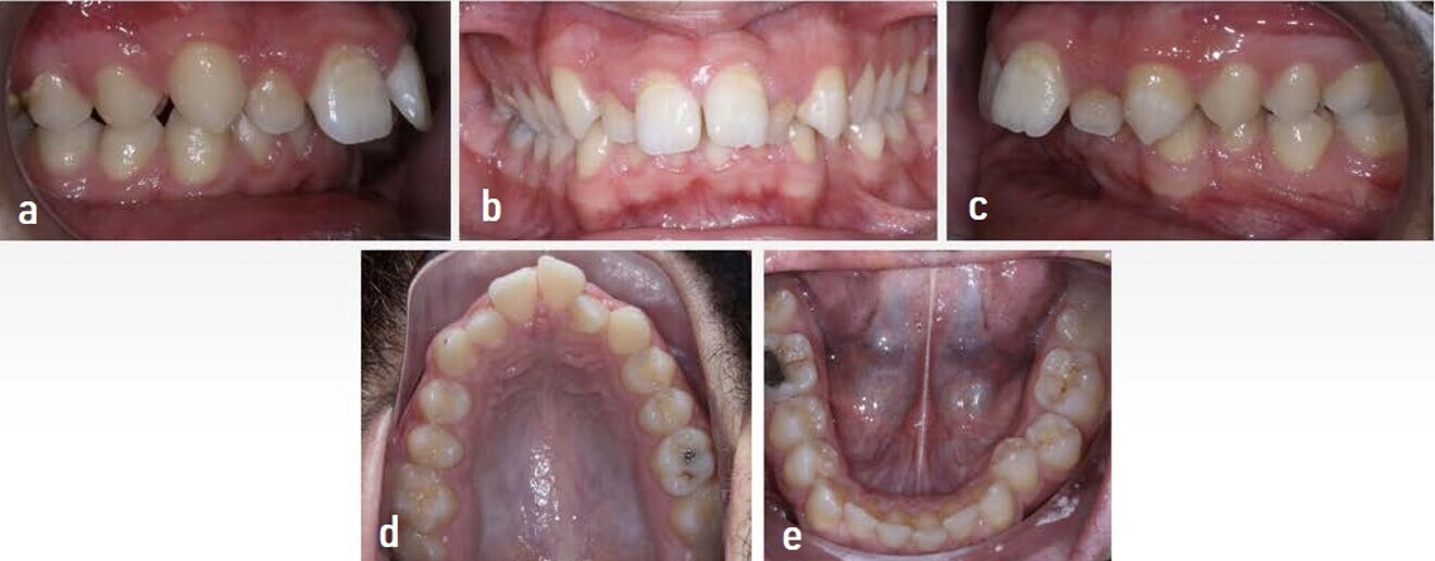 Figs. 2a–e: Initial intra-oral photographs. 
