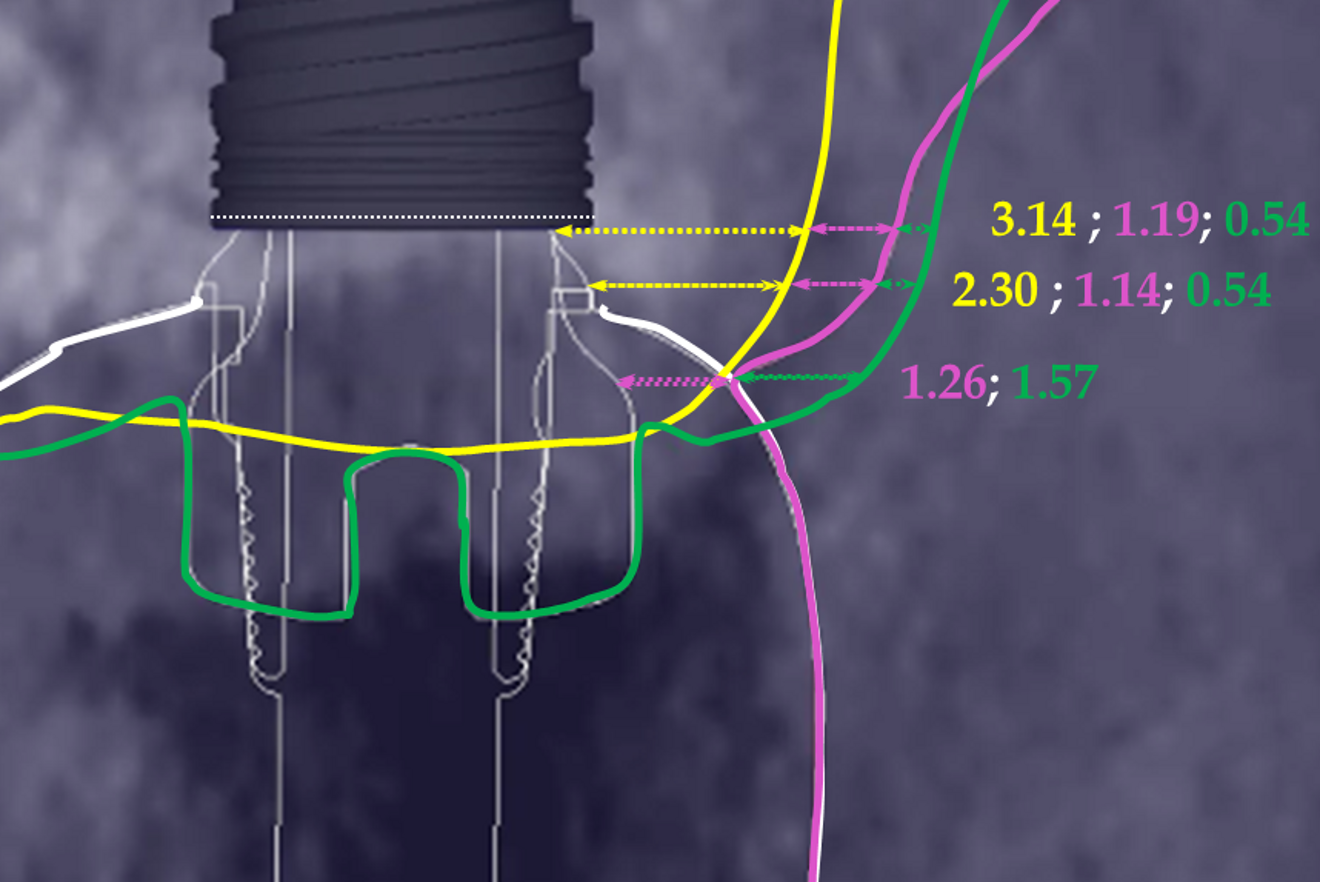 Fig. 7d: Measurement of the gingival width (GW) at various levels of the abutment, according to the various steps of implant therapy. Yellow line = pre-op. Green line = at the end of the healing period. Purple line = at prosthesis delivery. The numbers for each step are shown in the respective line colours.