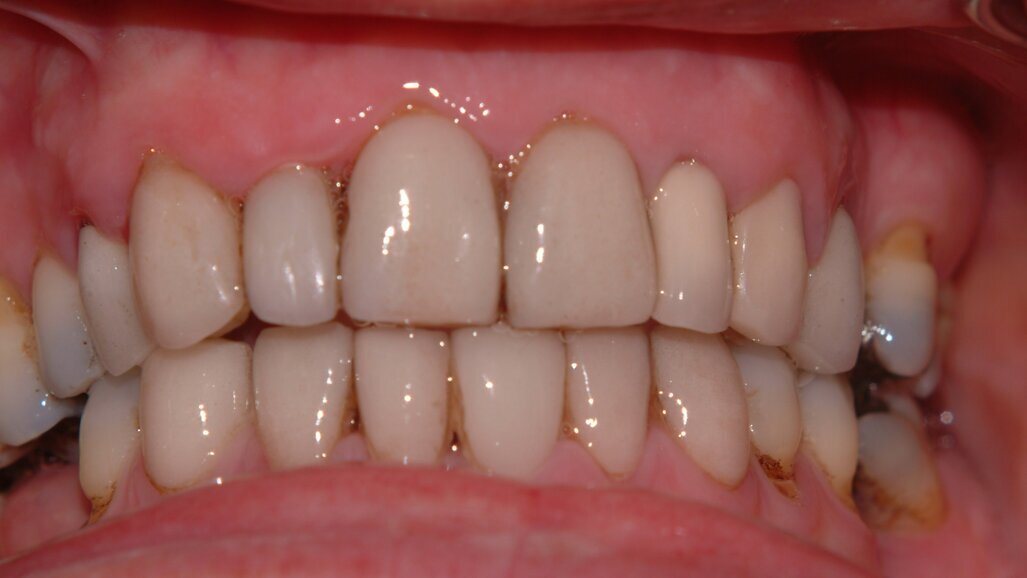 Porcelain Laminate Veneers – Avoiding Complications