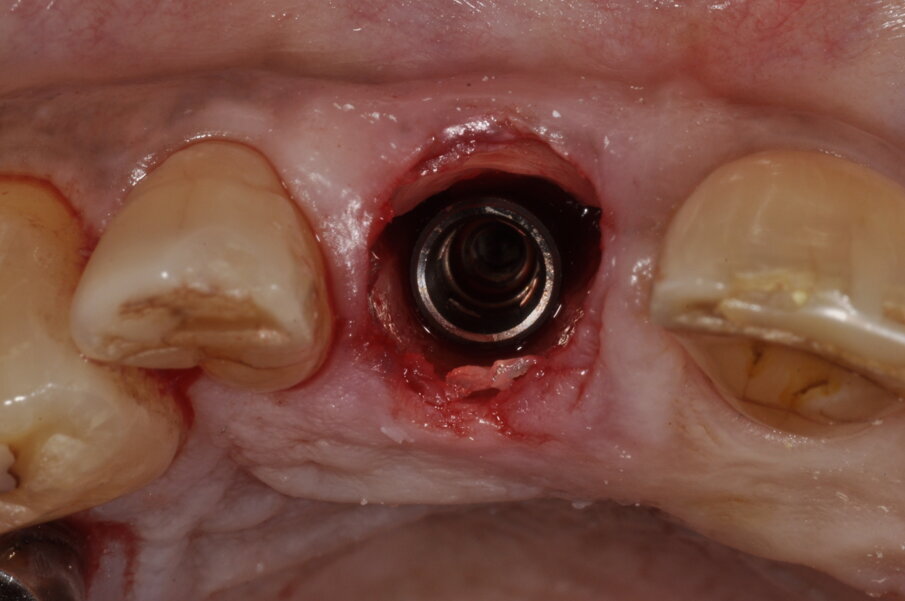 Udatta Kher socket shield 4