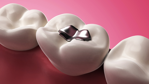 EU akzeptiert Amalgam – aber …