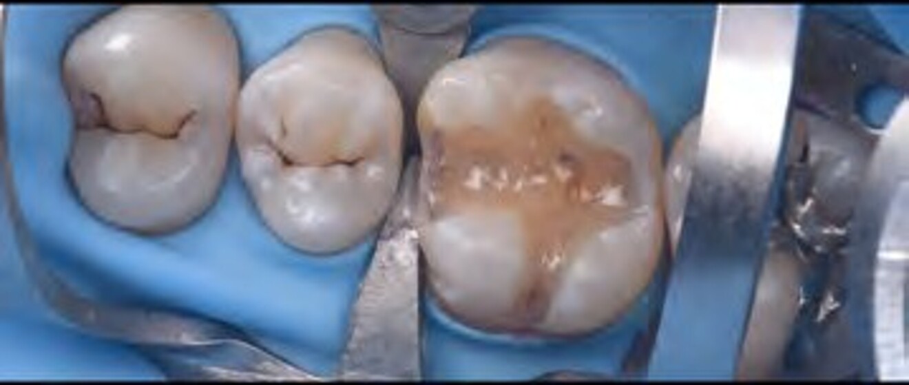 Fig. 2e: Gross contouring and occlusal  refinement performed after removal of excess restorative material. 