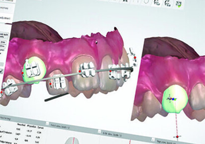 Digital Flash-Free Indirect Bonding System