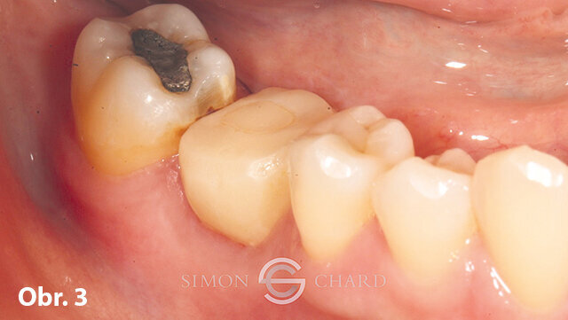 Dočasní korunka bez okluze