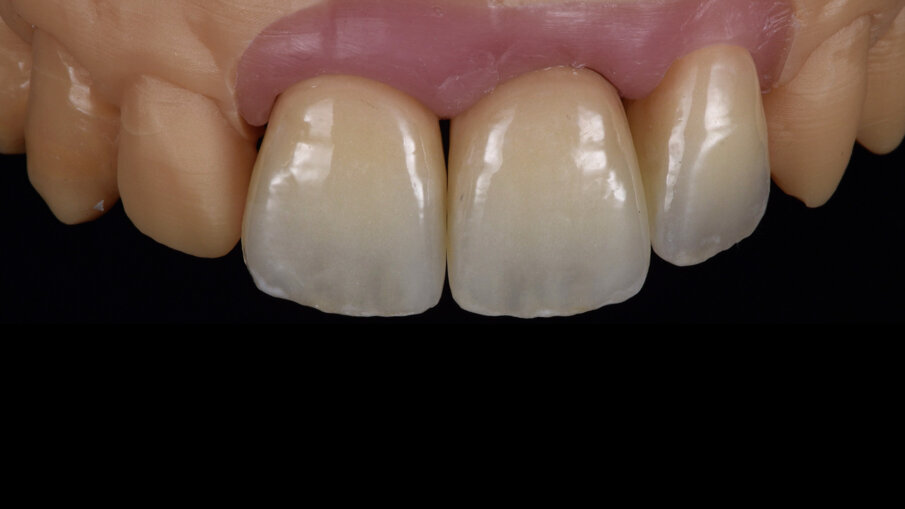 Figg. 12-14_Aspetto finale delle corone dopo le fasi di lucidatura meccanica.