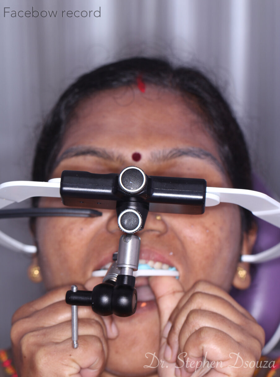 Fig. 5: Facebow record.