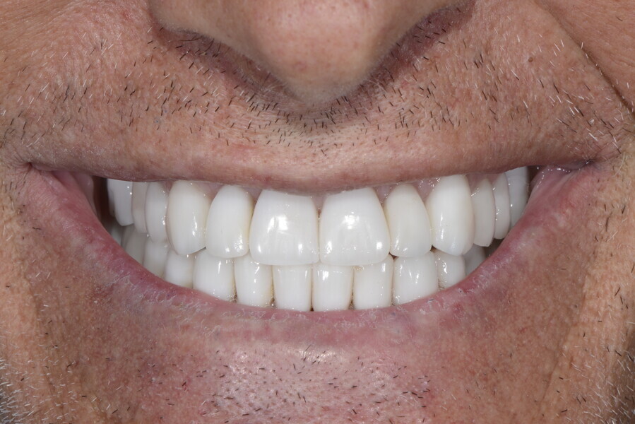 Fig. 27a: Final result with ceramic veneers on the anterior teeth and zirconia crowns on the implants in the posterior area. Frontal view of the patient’s final smile, mouth closed.