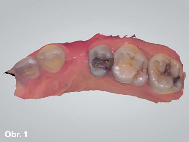 Sólo implantát: Kazuistika