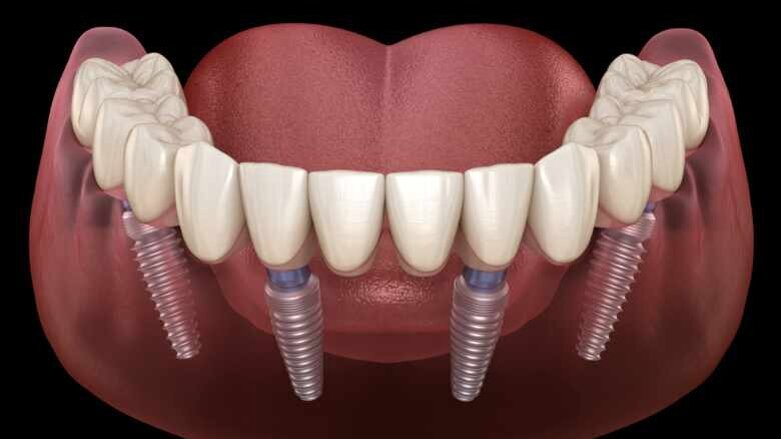 Forschungsprojekt zur Lebensdauer von Zahnimplantaten
