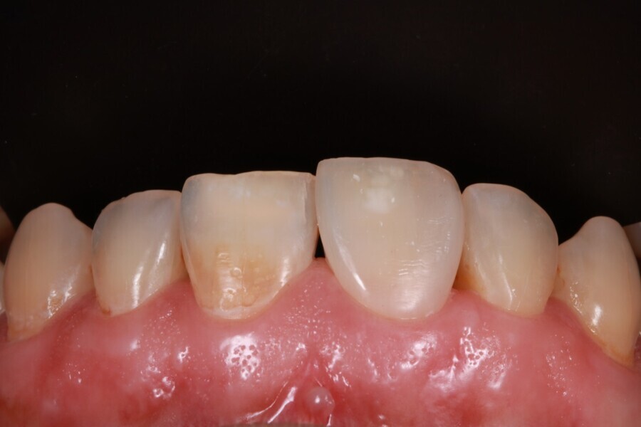 Figs. 5a-k: Composite veneers step by step. 