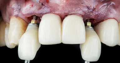 Immediate loading protocols are supporting global expansion of dental implants