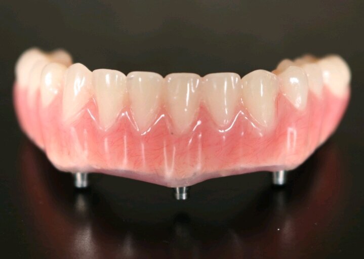 Same -Day-Prostheis fabricated