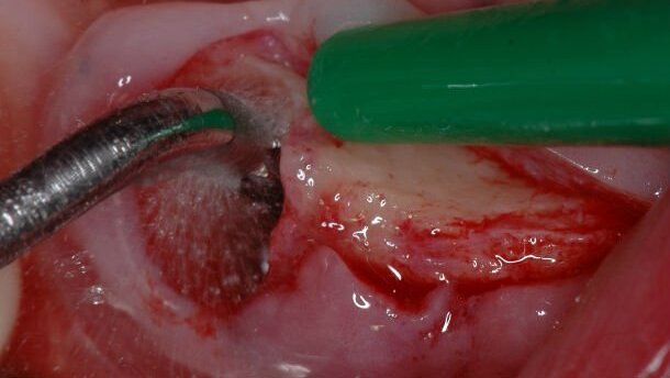 Chirurgia implantare minimamente invasiva nel paziente geriatrico a rischio