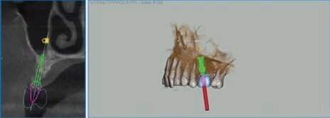 Fig. 4 - Misurazione radiologica e clinica dello spessore della cresta.